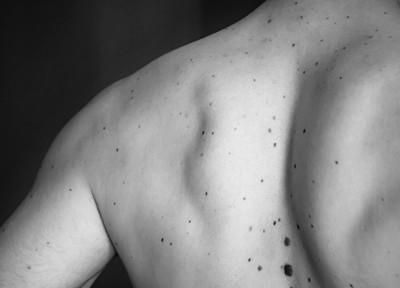 Why You Should Be Checking Your Moles