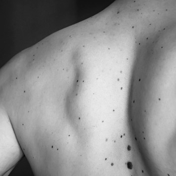  Why You Should Be Checking Your Moles